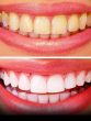 natural ways to whiten your teeth