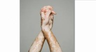World Vitiligo Day